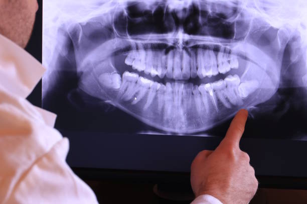 Best Emergency Wisdom Tooth Extraction in On Top Of The World Designated Place, FL